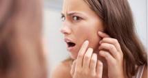 Tips Mengatasi Kulit Berjerawat (PeopleImages/Getty Images)