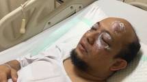 Novel Baswedan disiram air keras. (Foto: IST)