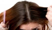  Ketombe Sebabkan Rambut Rontok, Benarkah?