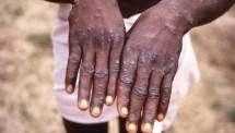 WHO menyamakan status wabah cacar monyet seperti Covid-19, yaitu darurat kesehatan global. (REUTERS/CDC/BRIAN W.J. MAHY) 