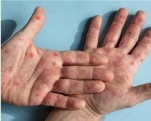 Waspada Kasus Cacar Monyet (MPOX), Hindari Gonta-Ganti Pasangan Seks, Cuci Tangan Rutin